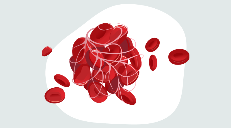 A clump of red blood cells held together by strands that are pale red to form a clot. There are some singular red blood cells.