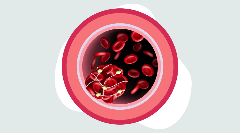 Concentric red circles in different shades represent a blood vessel and within it are red bloods cells. Some red blood cells are tied together, forming a clot.